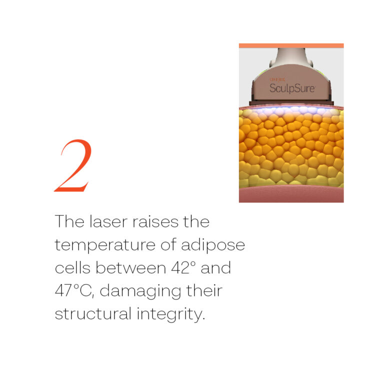 SculpSure Social Media Static Asset Carousel 4